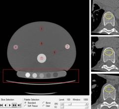 Mindways Solid幻影在质量保证幻影中具有感兴趣的体积(左侧红圈)。一名参与者在三椎骨小梁骨间室的无增强轴向CT(右侧)，显示感兴趣的体积(黄圈)，用于测量骨密度。图片由北美放射学会提供