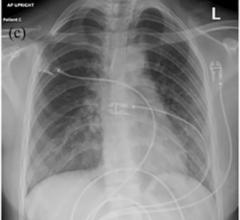 电子烟致肺损伤患者胸部x线图像。图片由加州大学校务#COVID19 #大流行#提供