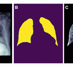 从影像数据中不恰当地去除特征可能导致偏差的例子。(A)肺炎男性患者胸片。(B)肺的分割掩码，使用深度学习模型生成。(C)胸片根据分割掩膜进行裁剪。如果裁剪过的胸片被输入后续的分类器用于检测实变，位于心脏后面的实变将被遗漏(箭头，a)。这是因为使用分割m去除了主要特征