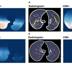 COVID-19(+)患者胸部CT图像示例及与COVID-19阳性相关特征可视化。对于每一对图像，左边的图像是CT图像，显示分割的肺作为仅在CT图像上训练的CNN(卷积神经网络算法)模型的输入，右边的图像是CNN模型分类为SARS-CoV-2感染的像素的热图(红色表示较高的概率)。(a)一名51岁女性，有发烧和接触沙士史
