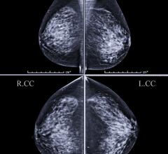 乳房成像2022世界杯篮球预选赛赛程和报告系统(BI-RADS)由美国放射学会建立，以帮助对乳房x光检查的发现进行分类。结果根据乳腺癌风险进行分类，BI-RADS 2病变为良性或非癌性，BI-RADS 6病变经活检证实为恶性。