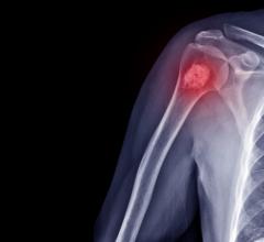 根据《骨与关节外科杂志》(The Journal of bone & Joint Surgery)对既往x光片的回顾，近20%的健康儿童可能存在良性骨肿瘤。该杂志由Lippincott与Wolters Kluwer合作出版。