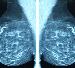 研究人员表示，在被诊断出乳腺癌之前，即使是跳过一次预定的乳房x光检查，女性死于癌症的风险也会显著增加。