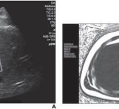 左:udff -操作者将横杆置于肝包膜处，样本ROI固定在横杆1.5 cm处，以确保测量足够深至肝包膜。总体UDFF为3%。右:三次采集的MRI中位PDFF为3%，显示一致。