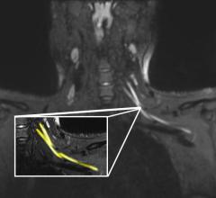 一个20岁出头的病人的磁共振图像显示颈部左臂丛神经损伤(黄色突出)。患者在从COVID-19呼吸道疾病恢复后出现左臂无力和疼痛，这促使他们去看初级保健医生。根据核磁共振检查结果，患者被转到COVID-19神经病学诊所进行治疗。图片由西北大学提供