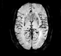 在Echelon Oval 1.5T MR扫描仪上拍摄的大脑图像