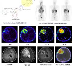 在注射后1、8和24小时注射64Cu-NOTA-EB-RGD的健康志愿者的代表性最大强度投影PET图像。注射64Cu-NOTA-EB-RGD患者注射后不同时间点的轴向MRI和PET切片。图片由张晶晶等人提供，中国北京协和医院/陈晓元等人提供，分子成像与纳米医学实验室，NIBIB/NIH, Bethesda，美国