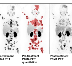 对正在接受治疗的患者的治疗前PSMA PET/CT的定量分析:¹纵横纵横Lutetium-PSMA-617/NOX66。治疗后PSMA PET/CT显示肿瘤体积和PSMA强度减小。图片由澳大利亚悉尼圣文森特医院的S Pathmanandavel和L Emmett制作。