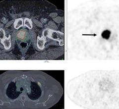 PSMA PET/CT准确检测67岁男性复发性前列腺癌。18F-DCFPyL-PSMA PET/CT显示前列腺广泛、强烈的psma狂热局部复发(下排;实箭头)与已知的前列腺肿瘤复发相一致。右图:PET显示前列腺广泛、强烈的psma局部复发(上排;实心箭头)和左肋骨2的孤立性骨转移(下排;虚线箭头)。图片由Ur Metser等提供。