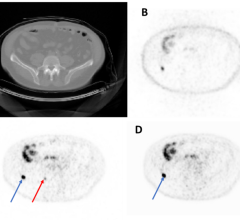 代表性轴向图像来自测试集成像研究。从左上到右下:CT (A)、NAC-PET (B)、原始AC-PET (C)、AI生成的AC-PET (D)。蓝色箭头表示在两张图像中均观察到的病变，红色箭头表示AI图像中未发现的病变(即核医学专家未发现的病变)。NAC =非衰减修正。AC = Attenuation-Corrected