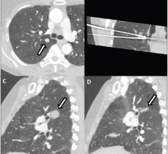 (A)术前胸部CT增强轴位图像显示右侧上叶实性结节1厘米，与右侧主支气管相邻(箭头)。(B)术中冠状面重构图像显示结节内有两个冷冻消融探头。(C)随访1个月的胸部矢状CT图像显示消融后包括治疗结节的预期变化(箭头)。(D)随访1年矢状位胸部CT图像显示治疗区预期退化为无残留肿瘤的扁平带状瘢痕