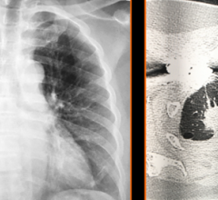 白色锁骨内侧头:图1:硬化累及第一肋软骨前连接处，继发于退行性改变，是一种常见的表现。在这种情况下，外观是不对称的，揭示了重叠肺癌。