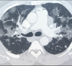 COVID-19患者CT扫描显示大量与SARS-CoV-2肺炎相关的磨玻璃病变。
