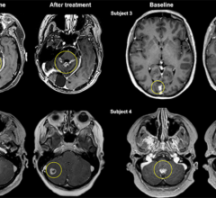 磁共振图像显示，聚焦超声通过血脑屏障提供抗体治疗后转移瘤的大小减小。