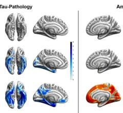 与一组年轻、健康、认知正常、淀粉样蛋白阴性的个体相比，超级老年人、正常老年人和轻度认知障碍患者的Tau(蓝色)和淀粉样蛋白(橙色)分布模式。脑投影以p < .0001的未校正显著性水平进行描述。颜色条表示各自的t统计量。图片由Merle C. Hoenig提供，神经科学和医学研究所II -大脑的分子组织，Juelich研究中心，Juelich，德国，原子核系