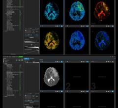 Random Walk Imaging AB (RWI)是一家为扩散磁共振成像(MRI)开发新型软件解决方案的公司，日前宣布推出其首个用于临床研究人员和放射科医生的商业软件产品。