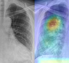 世界上最大的基于放射学的AI COVID-19诊断解决方案部署，使用基于AI的胸部x光技术