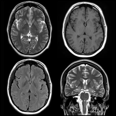 核磁共振显示多动症患者的大脑差异