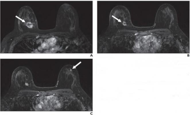 A，新辅助治疗开始前的基线MRI增强轴向t1加权脂肪饱和图像显示右上内侧乳房不规则肿块(箭头)，对应于活检证实的癌。B，新辅助治疗开始3个月后随访MRI的轴向t1加权脂肪饱和图像显示右乳腺癌尺寸减小(箭头)。C，新辅助治疗开始3个月后轴向增强t1加权脂肪饱和图像