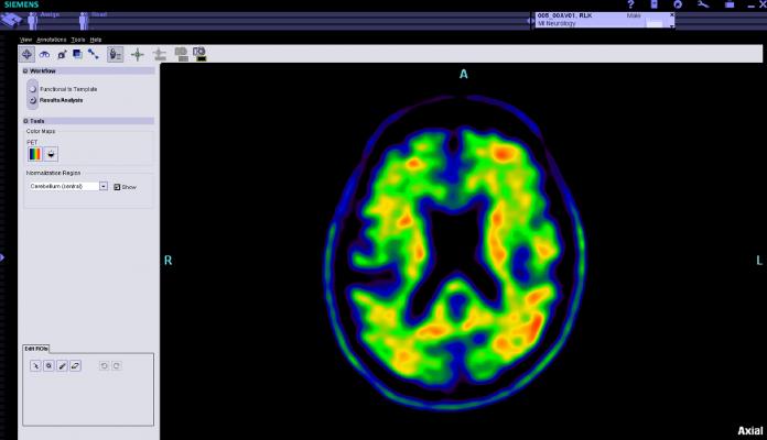 阿尔茨海默病协会，IDEAS研究，网站，参与，大脑PET扫描