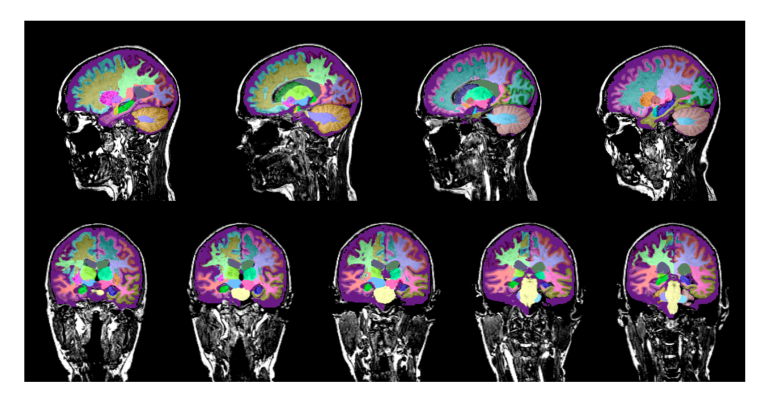 《神经读者报告》分析MRI序列，以确定大脑结构是否异常以及异常程度。在磁共振成像后不到十分钟，它就能可视化和量化45个个体的大脑结构