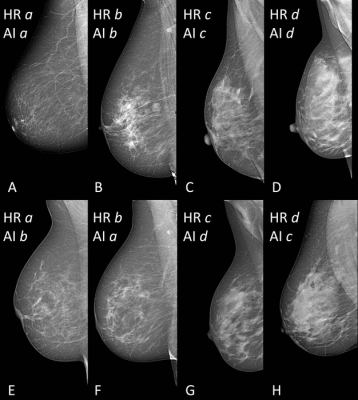 选择51 - 68岁女性不同乳腺密度的乳房x线中侧斜位片。