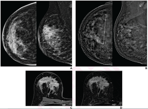 41岁，女性，右乳浸润性导管癌(G2，管腔B)