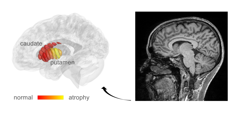 MRI图像用于检测早期PD患者的微观结构变化。与健康对照组相比，黄色区域是PD患者表现出组织损伤的区域。图片由希伯来大学Mezer实验室提供