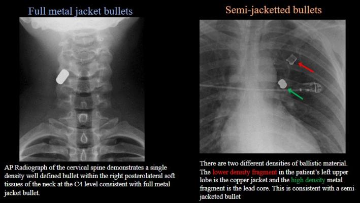 左:颈椎正位片显示单密度明确的子弹位于颈部C4水平右侧后外侧软组织内，与全金属外壳子弹一致。右:两种不同密度的弹道材料。左上肺叶的低密度碎片为铜夹套，高密度金属碎片与半夹套子弹的铅分一致。