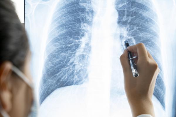 根据发表在《放射学》杂志上的一项新研究，肺部小气道疾病是COVID-19的一个潜在长期影响。