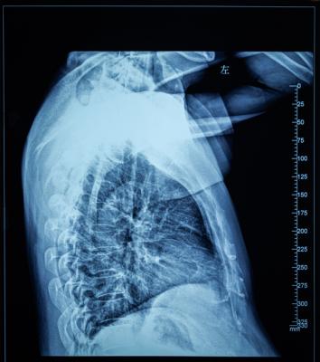 尽管肺癌患者的肿瘤接受了高剂量的辐射，但采用保留大部分食道的技术治疗的肺癌患者并没有出现严重的食道炎症