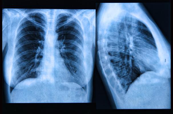 根据《放射学》杂志的一项新研究，修订后的肺癌筛查资格指南正在使种族/少数民族之间的差异持续存在。