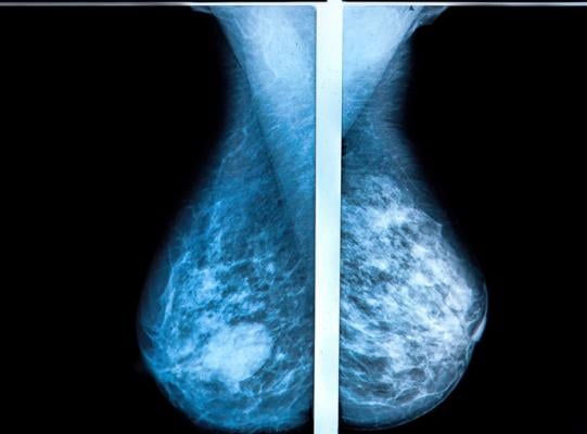 瑞典隆德大学(Lund University)的一项大型研究显示，与传统乳房x光检查相比，3-D乳房x光检查减少了常规筛查期间诊断出的乳腺癌病例数。研究结果发表在《放射学》杂志上。