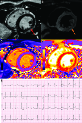 COVID-19疫苗相关心肌炎。1例19岁男性心肌心包炎短轴1.5T MRI图像和心电图显示，在第二剂信使rna -1273疫苗接种3天后出现胸痛。症状出现2天后的心脏MRI显示基底至中下侧壁的中壁至心外膜下晚期钆强化(LGE)，邻近心外膜强化(A，红色箭头)，相应的t2加权成像高强度(B，橙色)