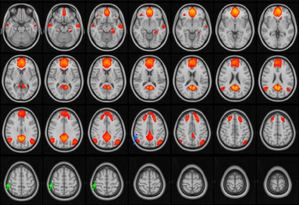 图1所示。大脑的MRI图像，默认模式网络(DMN)以橙色/红色突出显示。DMN在清醒休息时是活跃的，当大脑不专注于某一特定任务时。绿色和蓝色的箭头指向患有脑震荡的青少年患者大脑网络中被破坏的区域。