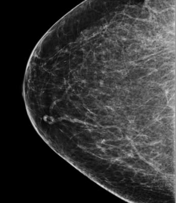 女性75多不可能受益于乳腺癌筛查