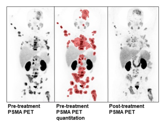 对正在接受治疗的患者的治疗前PSMA PET/CT的定量分析:¹纵横纵横Lutetium-PSMA-617/NOX66。治疗后PSMA PET/CT显示肿瘤体积和PSMA强度减小。图片由澳大利亚悉尼圣文森特医院的S Pathmanandavel和L Emmett制作。