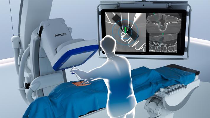 在这两个病例中，外科医生使用飞利浦脊柱套件解决方案，该解决方案提供了该公司的Azurion混合手术室(OR)和ClarifEye，这是一种行业首个解决方案，在低x射线剂量下将2D和3D可视化与3D AR导航结合到一个系统中。