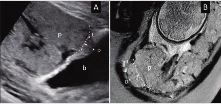 A) 28岁女性的超声检查(B) 34岁女性疑似PAS障碍的MRI检查。胎盘组织的病灶区域向正常子宫轮廓的虚线(虚线)隆起。胎盘隆起的长度(L)和深度(D)测量也显示出来。p =胎盘;b =膀胱。图片由美国伦琴学会(ARRS)、美国伦琴学杂志(AJR)提供