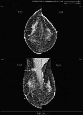 基于人工智能的计算机辅助检测(AI-CAD)可以在进行保乳治疗(BCT)监测乳房x光检查时降低假阳性结果