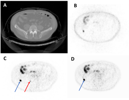 来自测试集成像研究的代表性轴向图像。从左上到右下:CT (A)， nacc - pet (B)，原AC-PET (C)， AI生成的AC-PET (D)。蓝色箭头表示两个图像中均观察到的一个病变，红色箭头表示AI图像中未发现的病变(即未被核医学专家发现)。非衰减校正。AC = Attenuation-Corrected