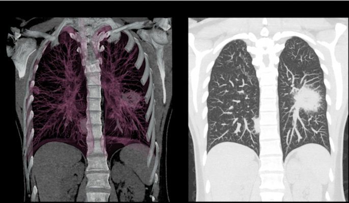 根据发表在《胸部肿瘤学杂志》上的一项研究，使用低剂量计算机断层扫描检测出的原发性肺癌患者在诊断后发生脑转移的风险降低。