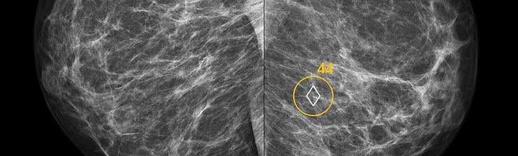 ScreenPoint Medical获得FDA批准开发透明乳房x光造影AI解决方案