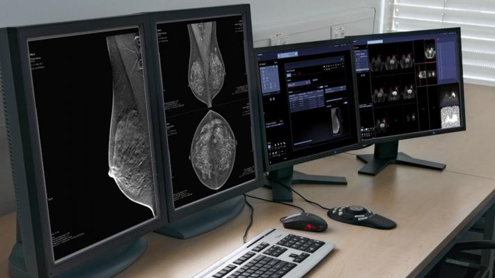 西门子Healthineers Syngo。乳房护理增加基于人工智能的决策支持
