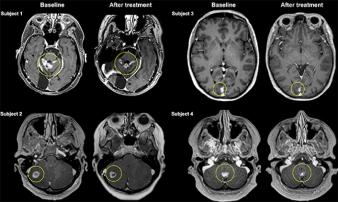 磁共振图像显示转移性肿瘤缩小后，聚焦超声输送抗体治疗通过血脑屏障。