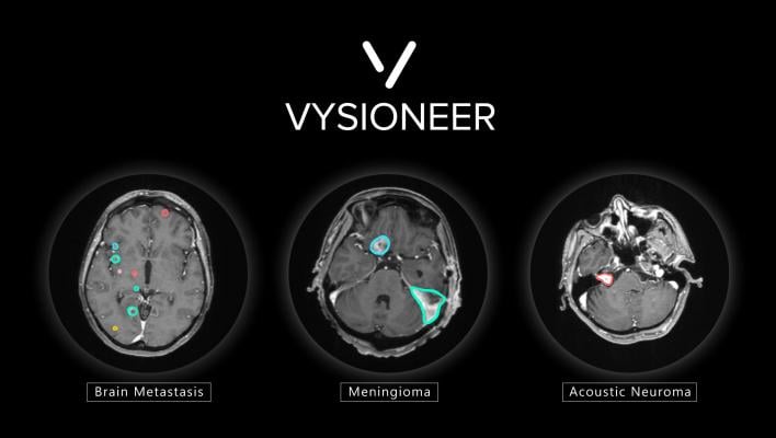 脑瘤被人工智能淘汰:VBrain将自动轮廓绘制应用于三种最常见的脑瘤:脑转移瘤、脑膜瘤和听神经瘤。