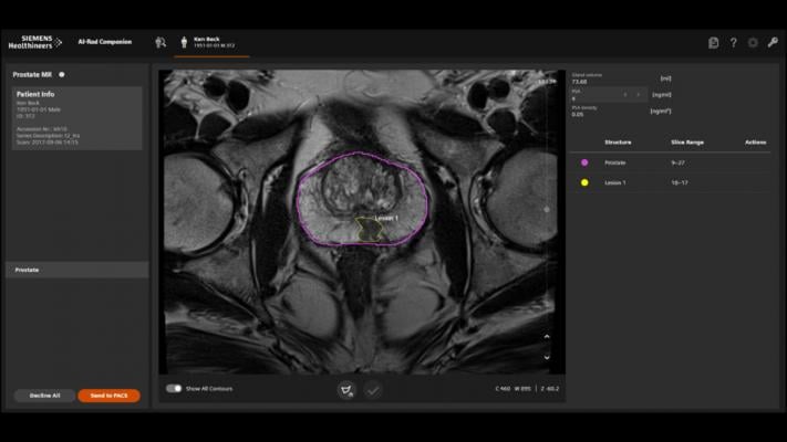 AI-Rad伴前列腺MR活检支持段前列腺在MRI和超声融合成像下的靶向活检