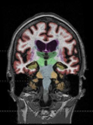 钆造影剂在大脑MRI中的表现