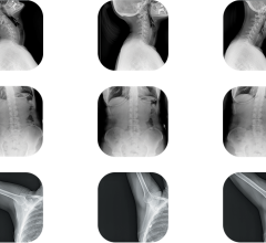 柯尼卡美能达医疗保健美洲公司的一个部门20/20 Imaging宣布FDA批准了捏脊直臂(CSA)的动态数字放射术(DDR)。