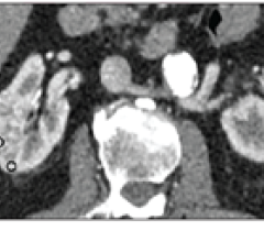 对于小(≤4cm)肾实体肿块的透明细胞肾细胞癌(RCC)， 5层CT评分算法可能是一种临床有用的诊断工具。